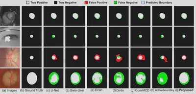 Qualitative segmentation comparison across cardiac MRI, eye, and retinal fundus images. Each row is one image; columns show (a) image, (b) ground truth, and predictions from (c) U-Net, (d) Swin-Unet, (e) Dcan, (f) Dmtn, (g) ConvMCD, (h) ActiveBoundary, (i) the proposed D-Convexity. Baselines produce fragmented holes (green false-negatives) and spurious lobes (red false-positives), while D-Convexity returns clean, simply-connected, convex regions that closely follow the ground truth boundary.